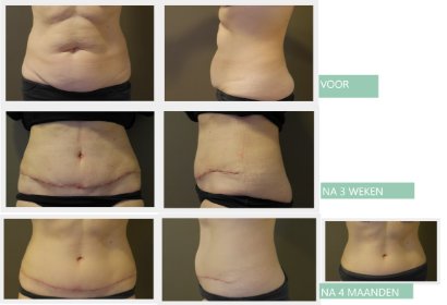 Tummy Tuck after 3 weeks and after 4 months