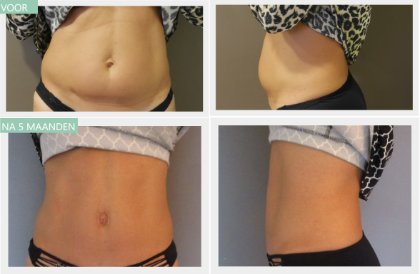 Tummy Tuck after 5 months