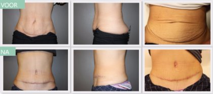 Tummy tuck before and after