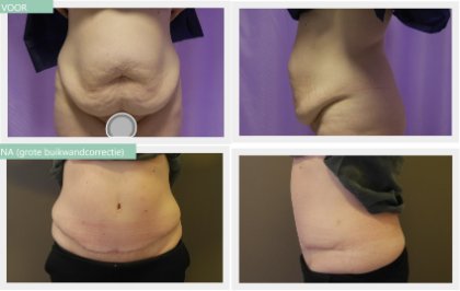  tummy tuck large