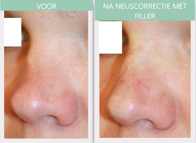 Neuscorrectie met filler