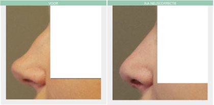 Nose job piezo Dr Nelissen