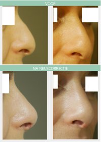 Nose job before and after Dr Nelissen