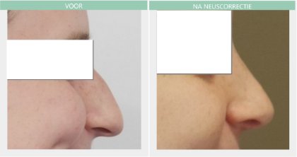 Nose job before and after Dr Nelissen