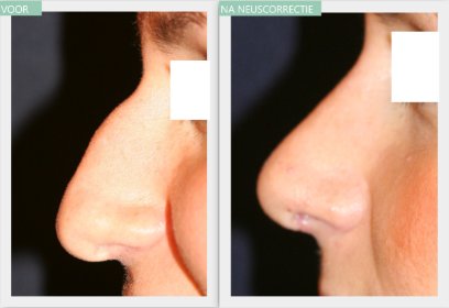 Nose job before and after Dr Nelissen