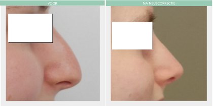 Nose job before and after Dr Nelissen