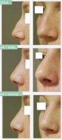 Nose job before and after Dr Nelissen 