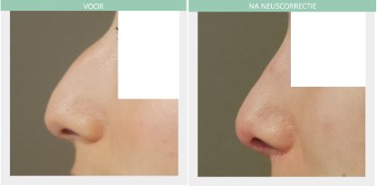 Nose job before and after Dr Nelissen