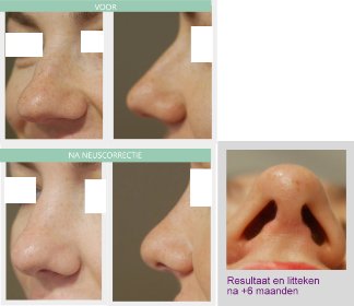 Nose job scar Dr Nelissen