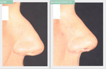 Nose job before and after Dr Nelissen 