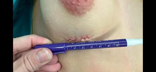 Minimal-scar Breast Augmentation