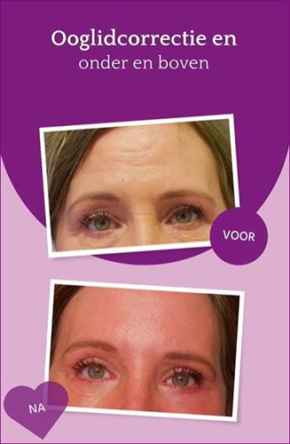 Eyelid correction: new before and after photos