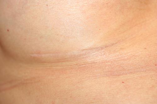 QUESTION 3: WHAT DOES THE SCAR LOOK LIKE AFTER A BREAST AUGMENTATION?
