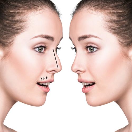 NOSE SURGERY