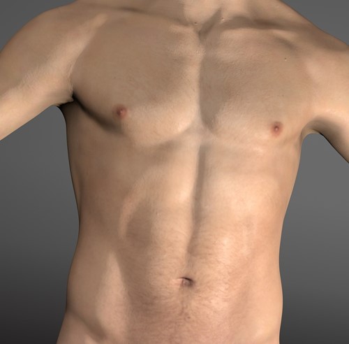 Gynecomastia