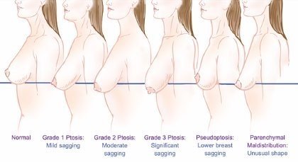 Breast lift Global Care Clinic graden van ptosis