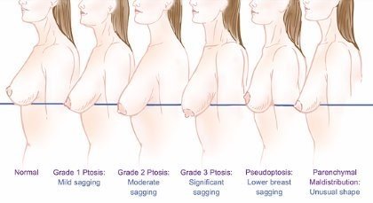 Bruststraffung Global Care Clinic Grad der Ptosis