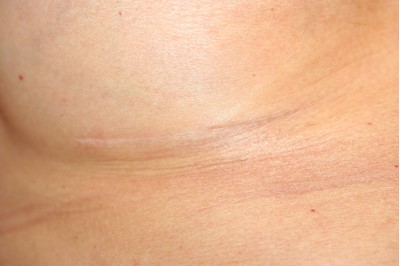 Scar after breast augmentation
