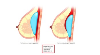 Breast implant in front or behind the muscle
