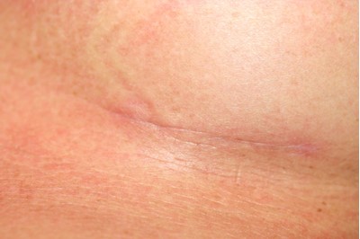 Breast augmentation scar