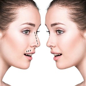 Ultrasonic nose job by Dr Nelissen