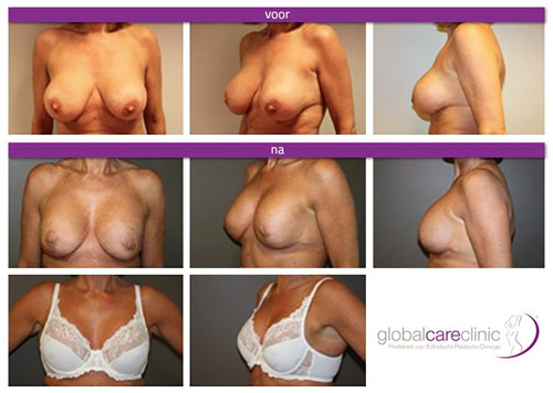 Voor en na borstimplantaatwissel