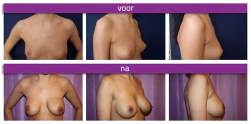 Breast Implant Revision