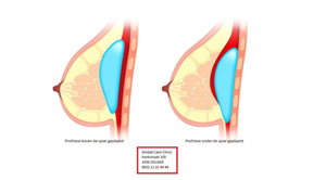 Platzierung der Brustprothese vor oder hinter dem Muskel