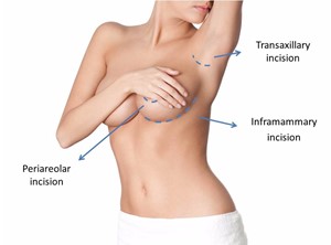 Incision and scar breast augmentation