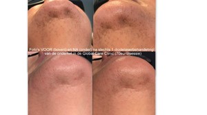 Global Care Clinic before and after laser hair removal