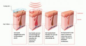 Global Care Clinic laser hair removal