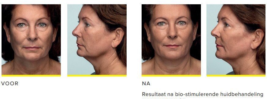 Radiesse filler voor en na Collageen test