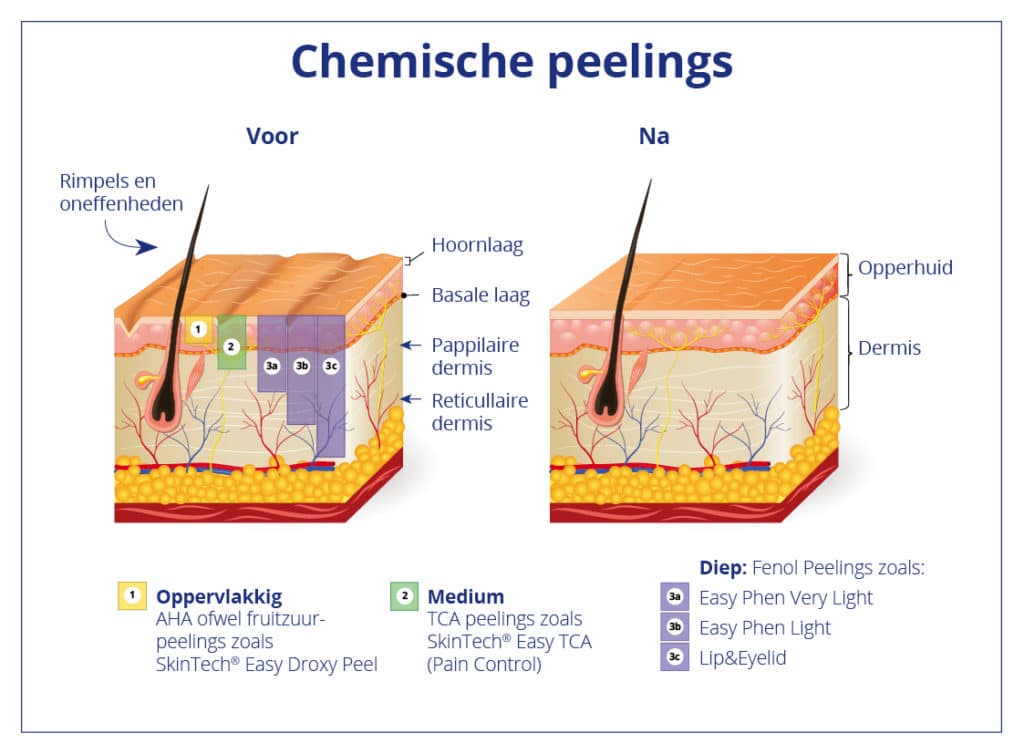 verschillende soorten peeling op basis van de dieptewerking