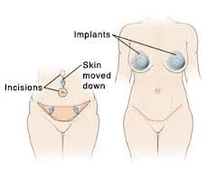 mommy makeover Dr Nelissen