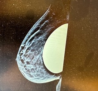 Mammografie na borstvergroting