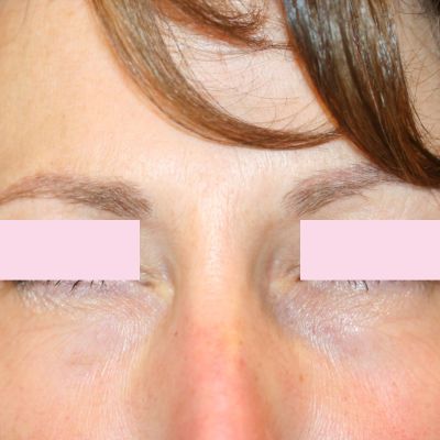 BOTOX fronsrimpel na