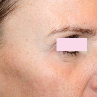 BOTOX kraaienpootjes na 1