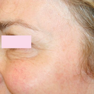 BOTOX kraaienpootjes na