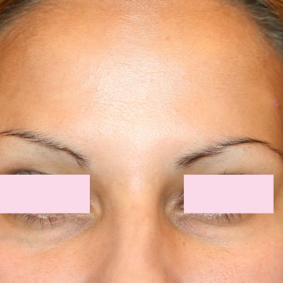 BOTOX voorhoofd na