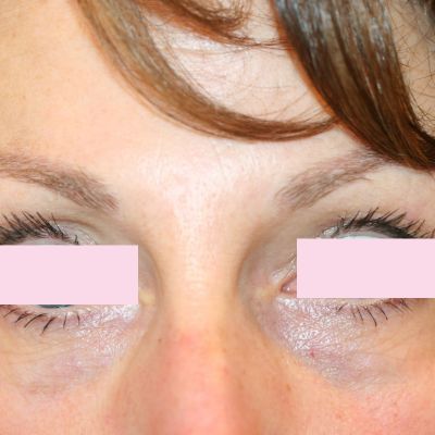 BOTOX voorhoofdrimpel na