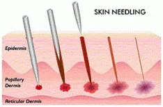 Medische Dermapen needling Dr Nelissen