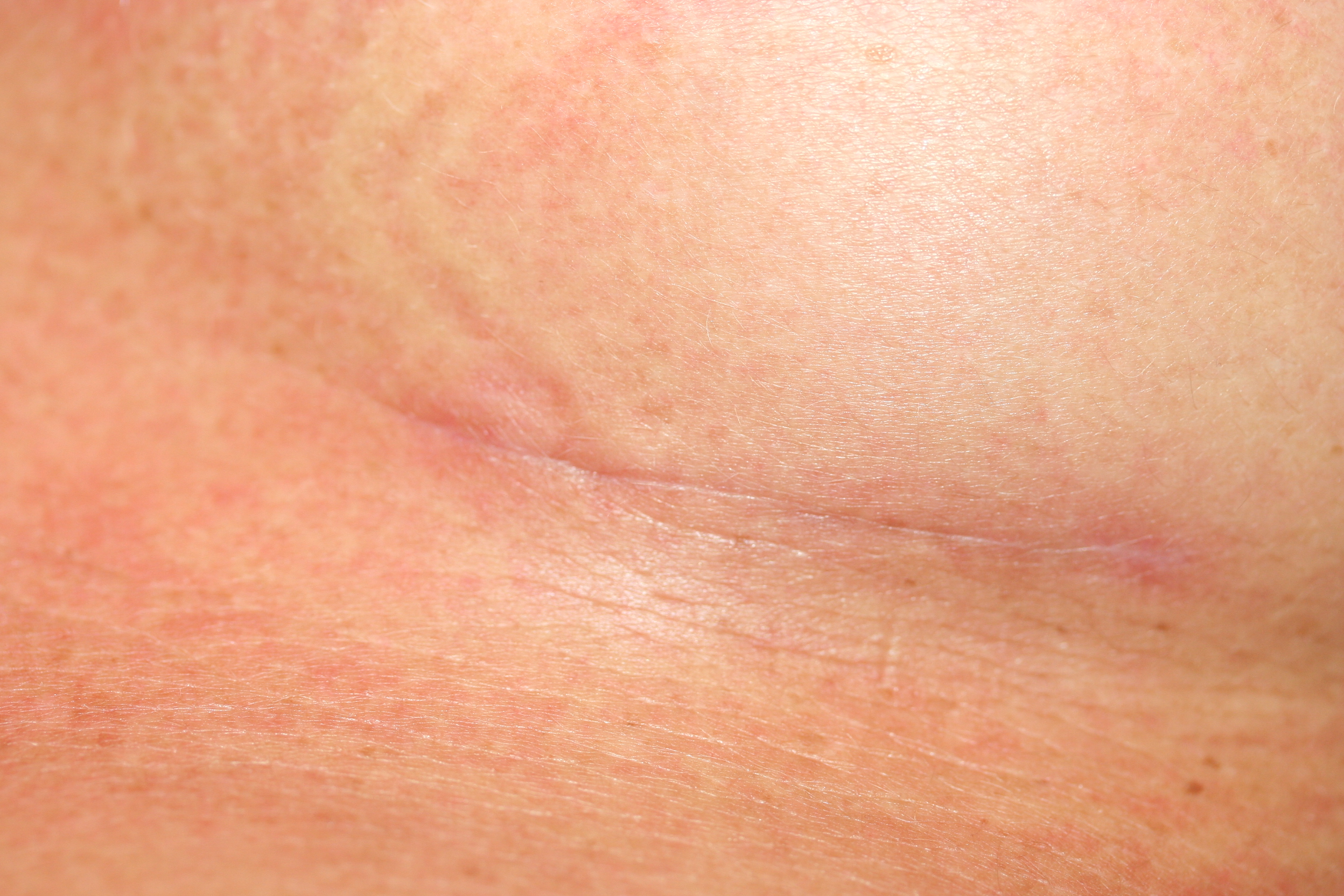 Augmentation Scae Minimal scar breast augmentation - Global Care Clinic