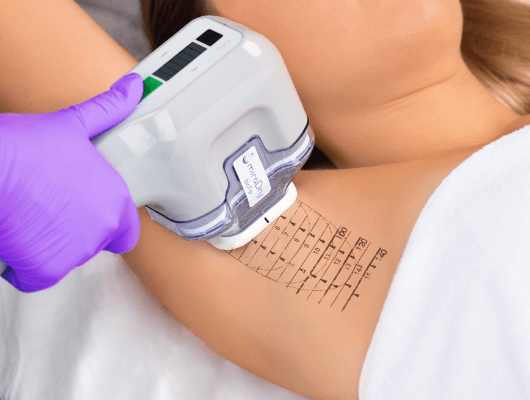 Animatie miradry behandeling