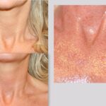 Medische Needling