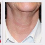 Medische Needling