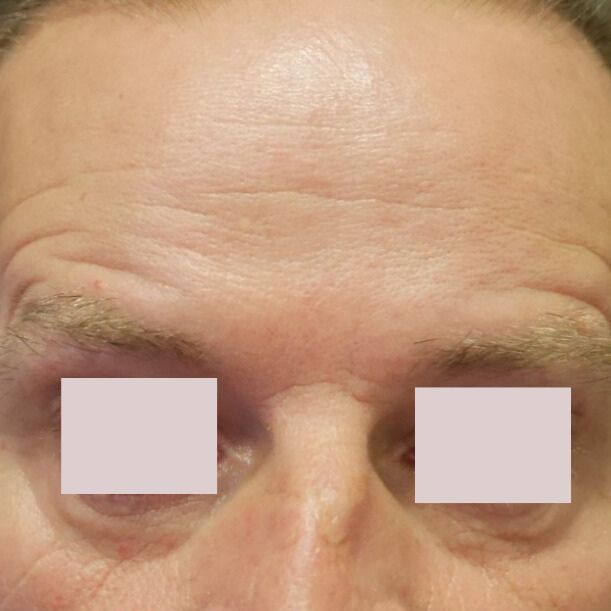NA botox man voorhoofd