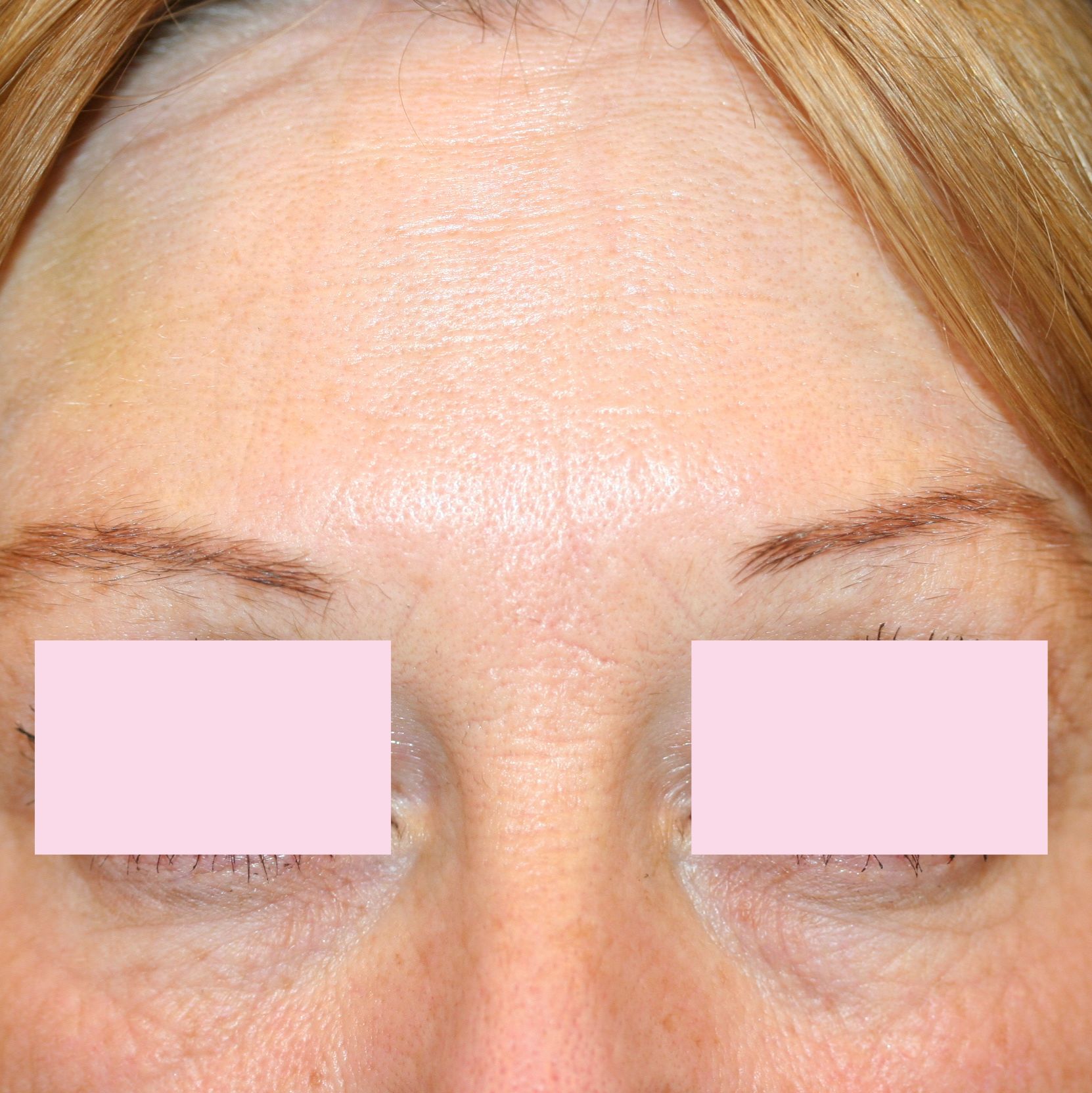 NA botox voorhoofd