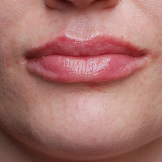 NA lipfiller