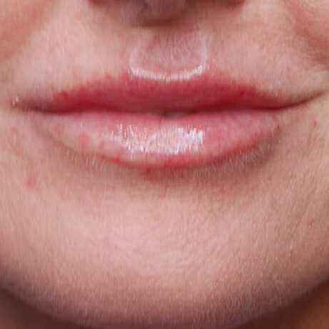 NA lipfiller
