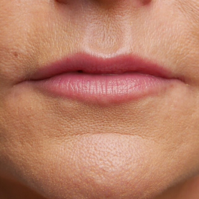 NA lipfiller